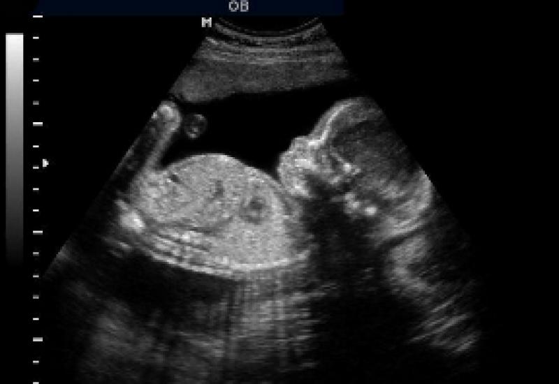 Kokia yra paklaidos tikimybė nustatant vaiko lytį ultragarsu Šiuolaikinės ultragarso klaidos nustatant vaiko lytį