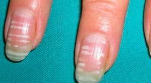 Shkaqet e njollave të bardha në thonjtë dhe metodat e trajtimit Pika e bardhë në thoin e gishtit të vogël