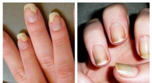 Snabba och effektiva sätt att diagnostisera och behandla nagelsvamp