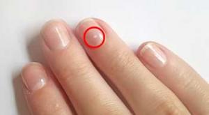 Reasons for the appearance of white spots on nails Why white spots on fingernails