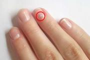 Orsaker till vita fläckar på naglar Varför vita fläckar på naglar
